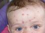 Epidémie de varicelle : douze régions touchées