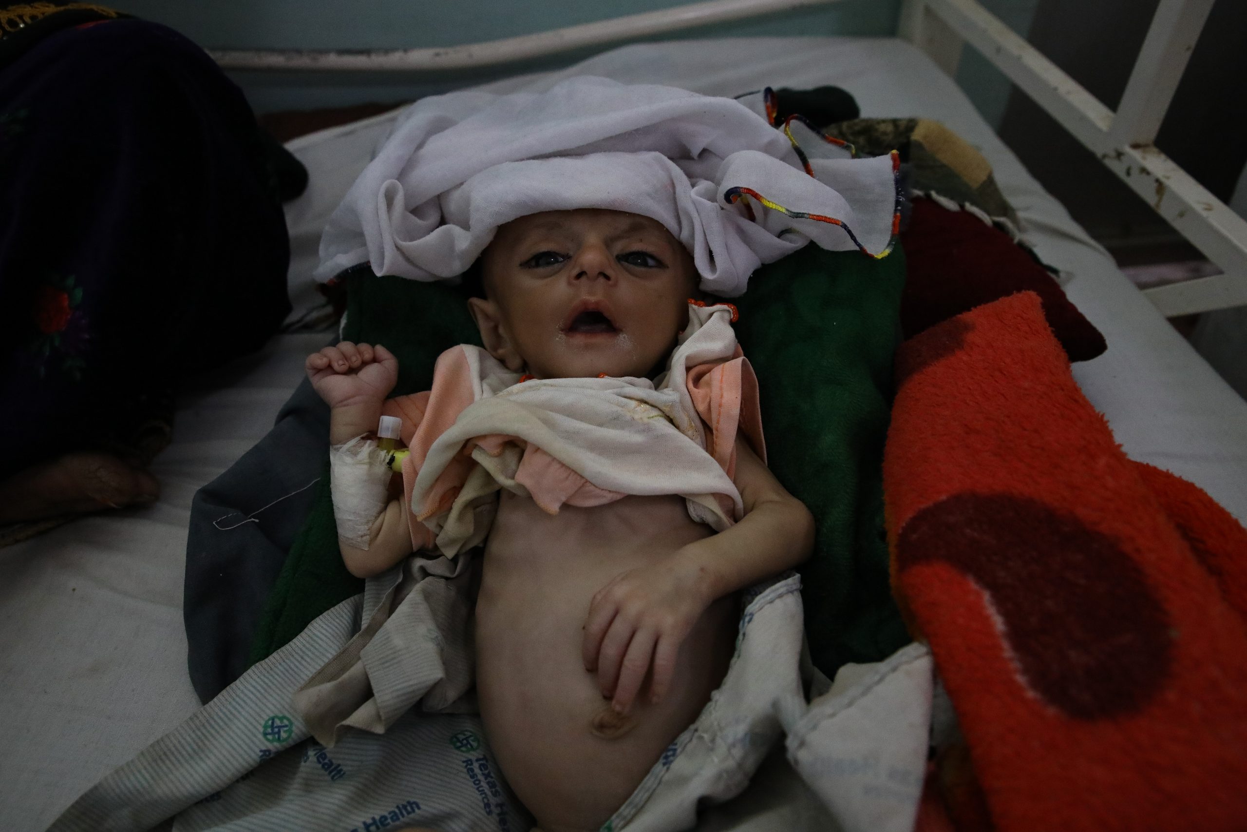 Agé de cinq mois, Ali souffre de malnutrition sévère. Hospitalisé depuis deux jours à l'hôpital Mirwais, à Kandahar, il pèse 3,5 kilos