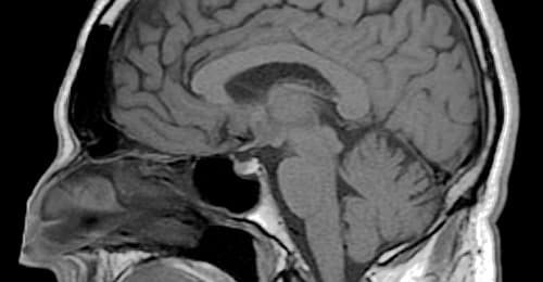 L’AVC frappe un nombre croissant de 20-64 ans dans le monde